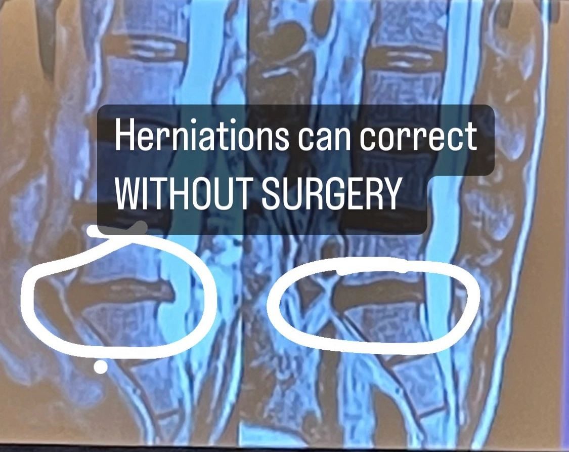 An annotated MRI from the practice with two disc levels circled, captioned by the clinic: herniations can correct without surgery.